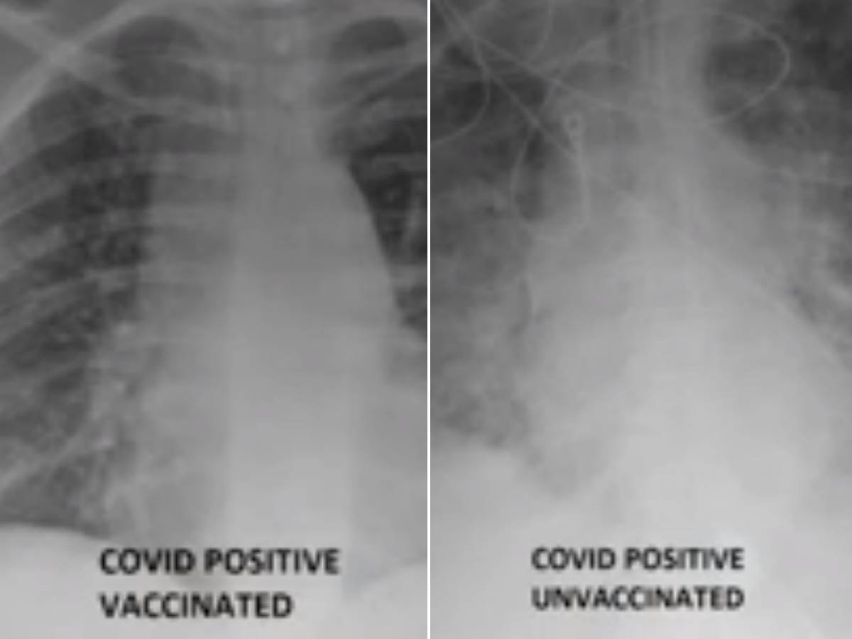  Snimak pluća vakcinisanih i nevakcinisanih pacijenata sa koronom 