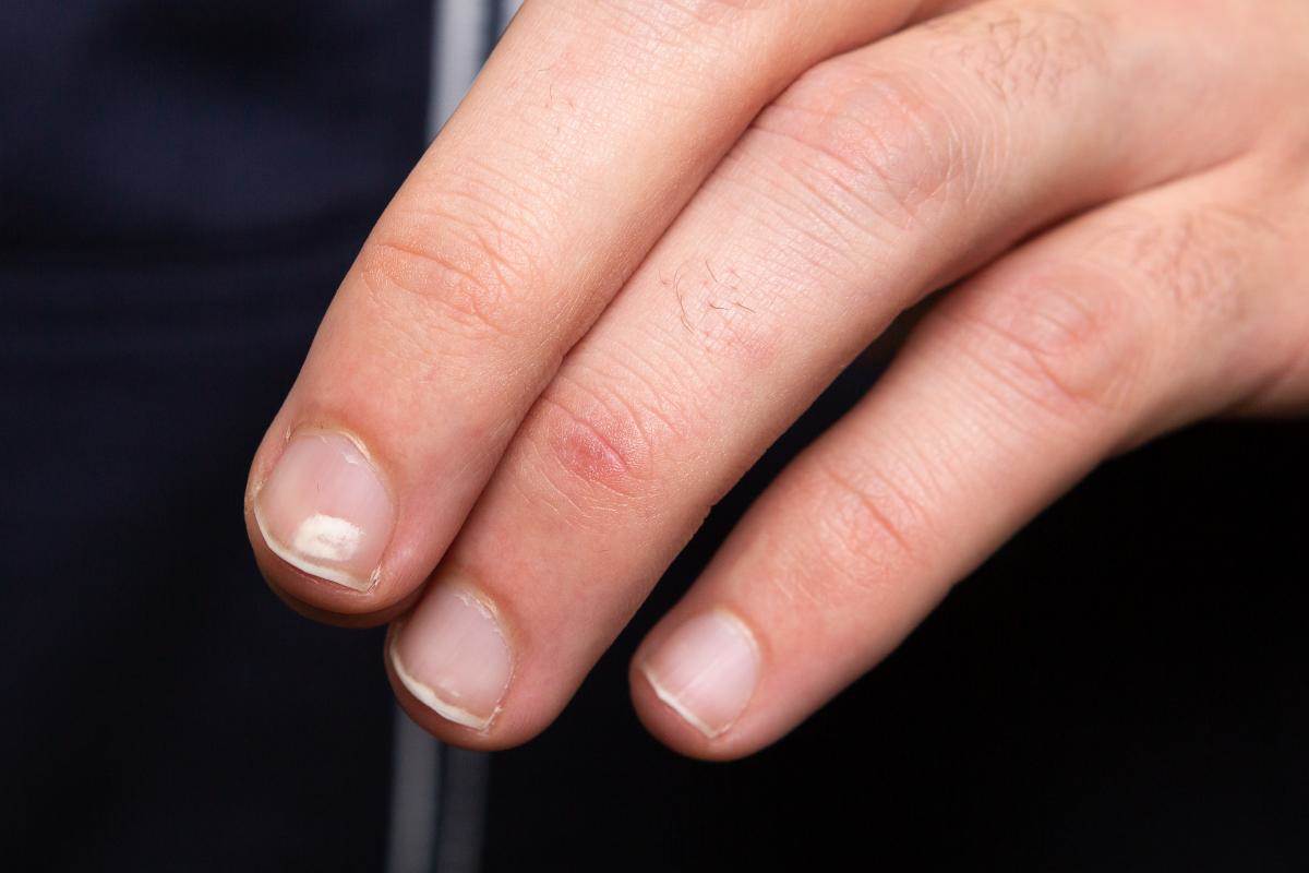  Zašto se na noktima javljaju bele mrlje 