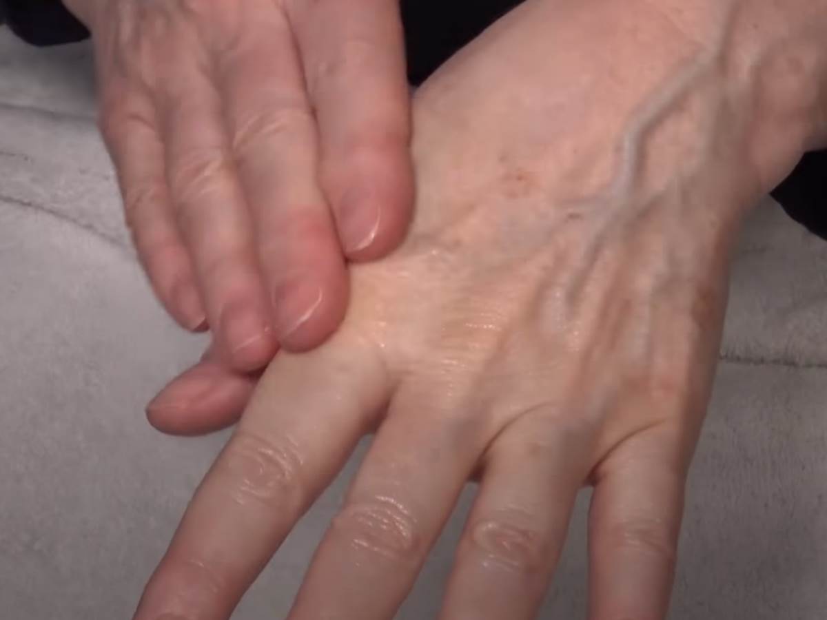  Simptom preležane korone požuteli nokti 