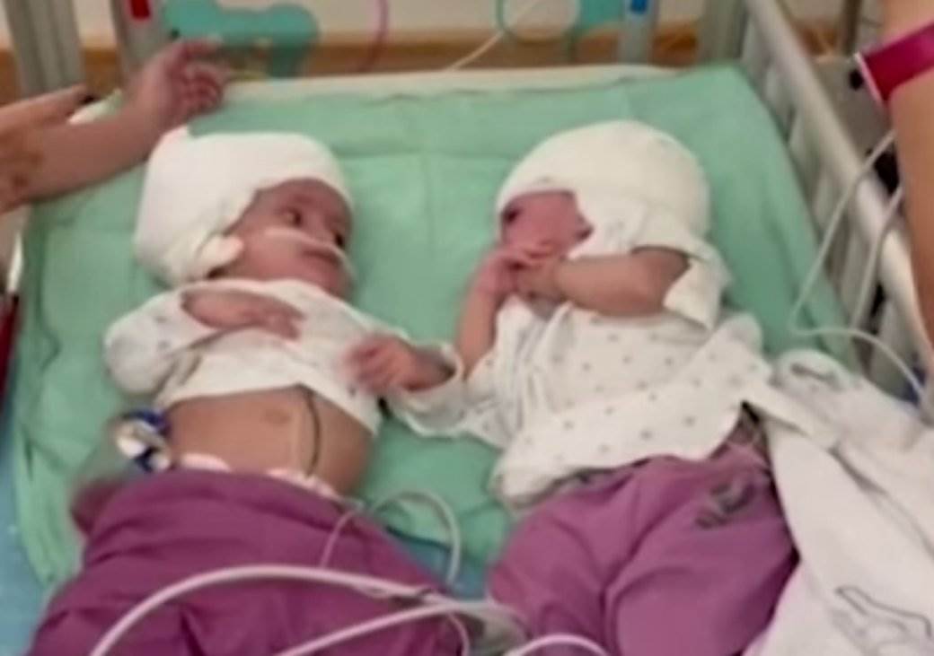  Bliznakinje spojene od rođenja se operisale u Izraelu 