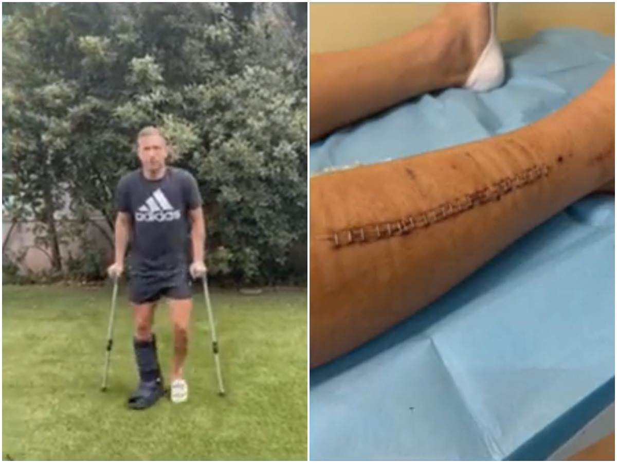  Fudbaler Juventusa pokazao nogu posle operacije 