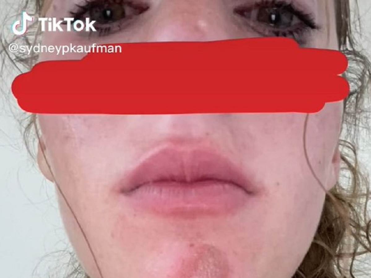  Devojka pokazala kako izgleda alergija na bradu 