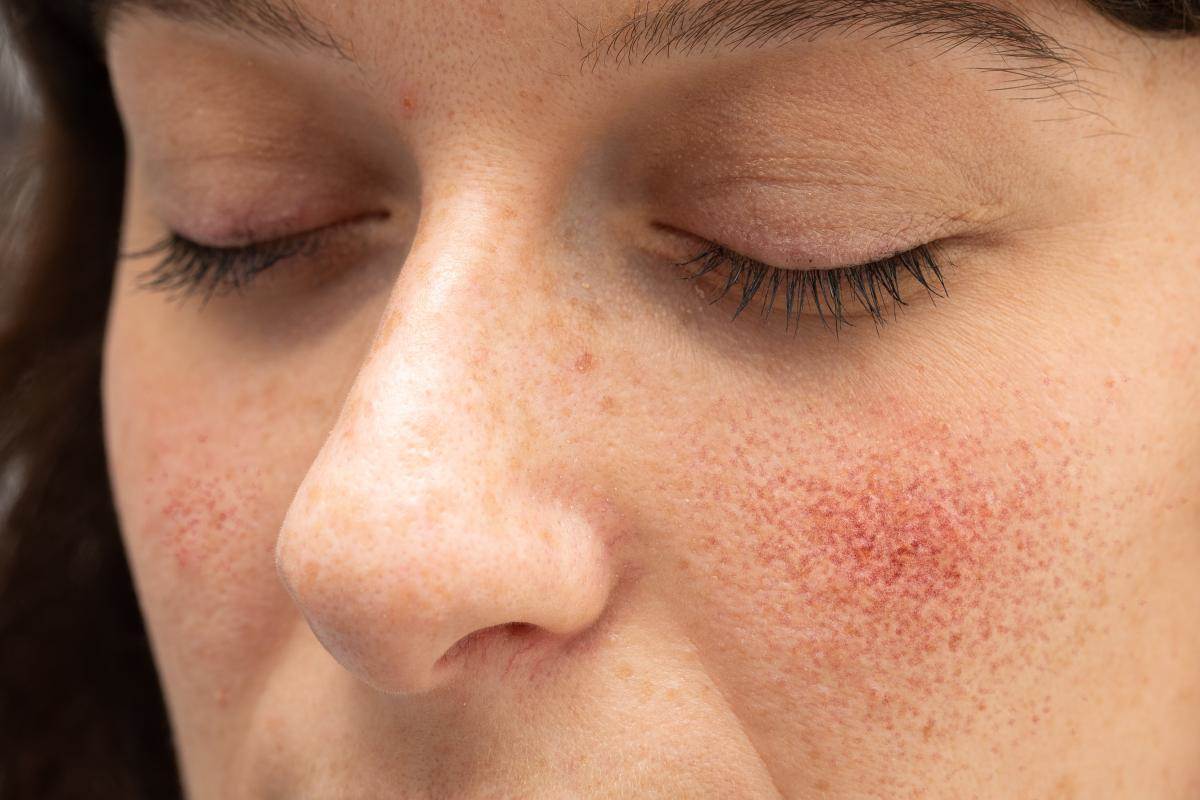  Simptom lupusa na koži 