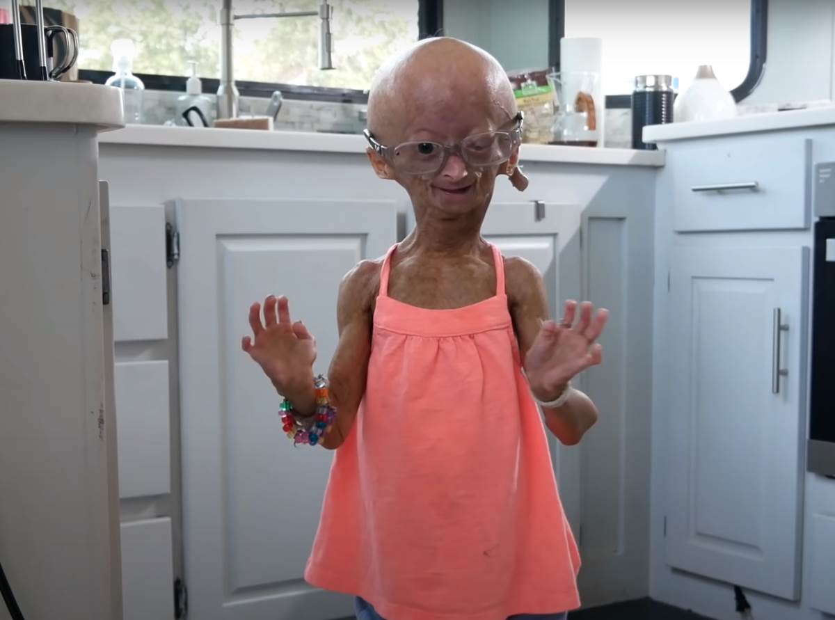  Umrla devojčica koja je bolovala od progerije 