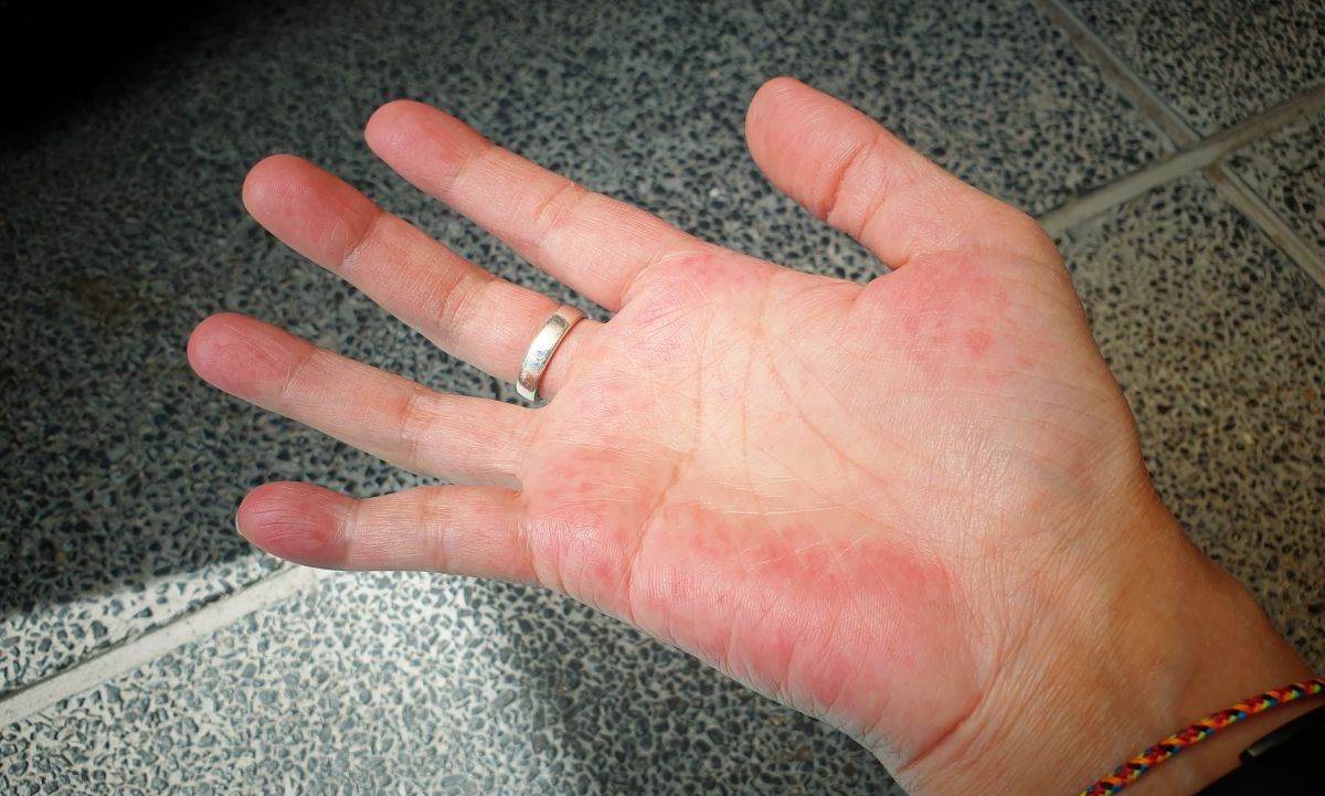  Simptomi bolesti jetre na rukama  