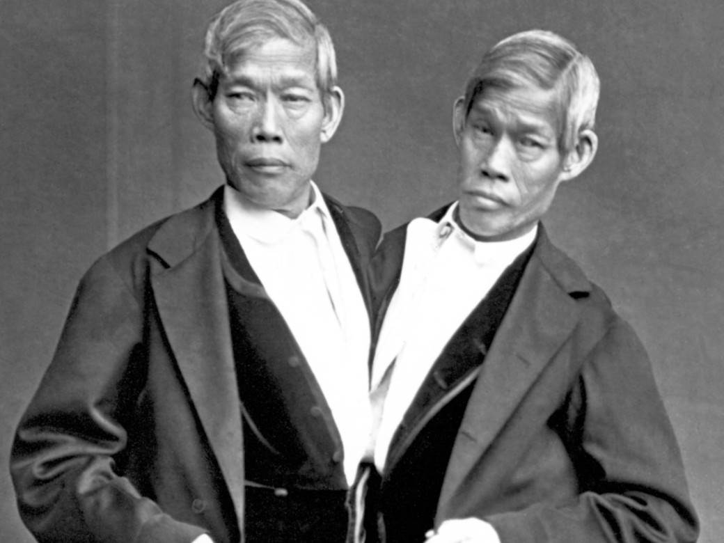  Prvi sijamski blizanci na svetu 