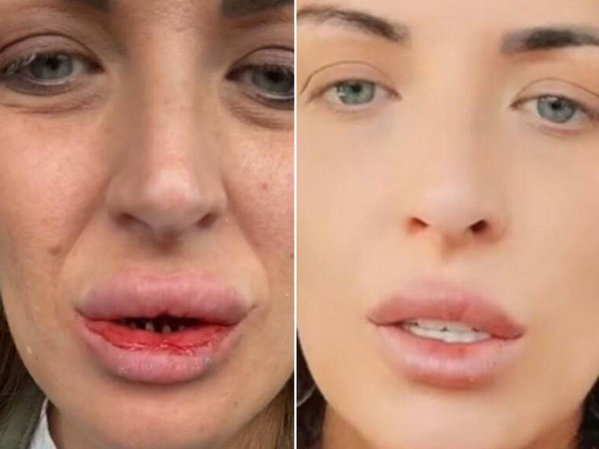  Iskustvo žene koja je operisala zube u Turskoj 