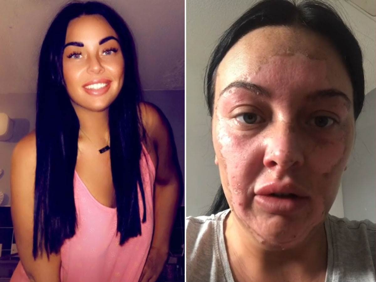  Devojka dobila opekotine na licu zbog trika sa jajetom 