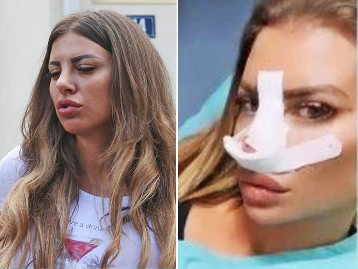  Dragana Mitar s otečenim nosem posle operacije 