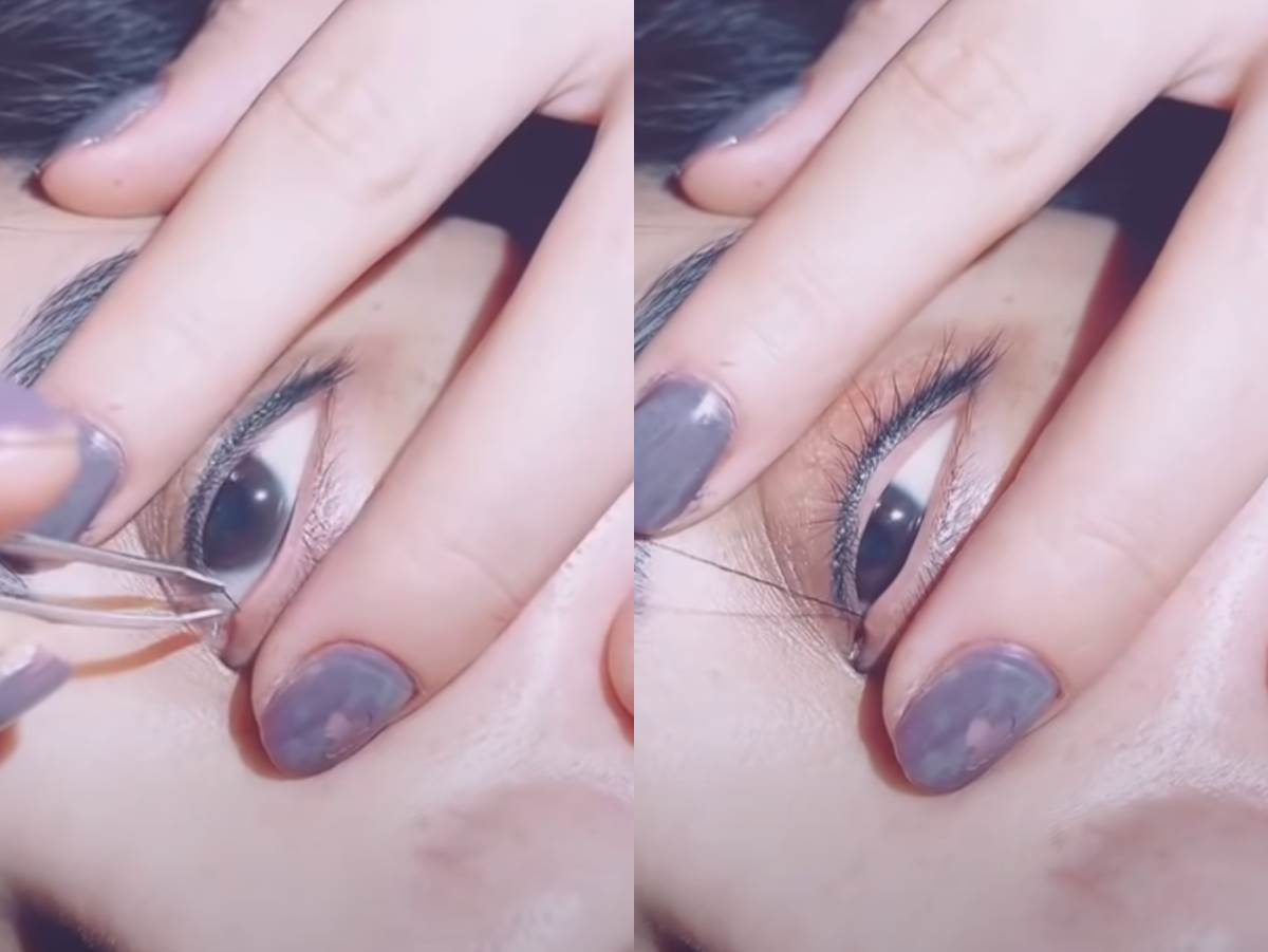  Snimak izvlačenja urasle dlake iz oka 