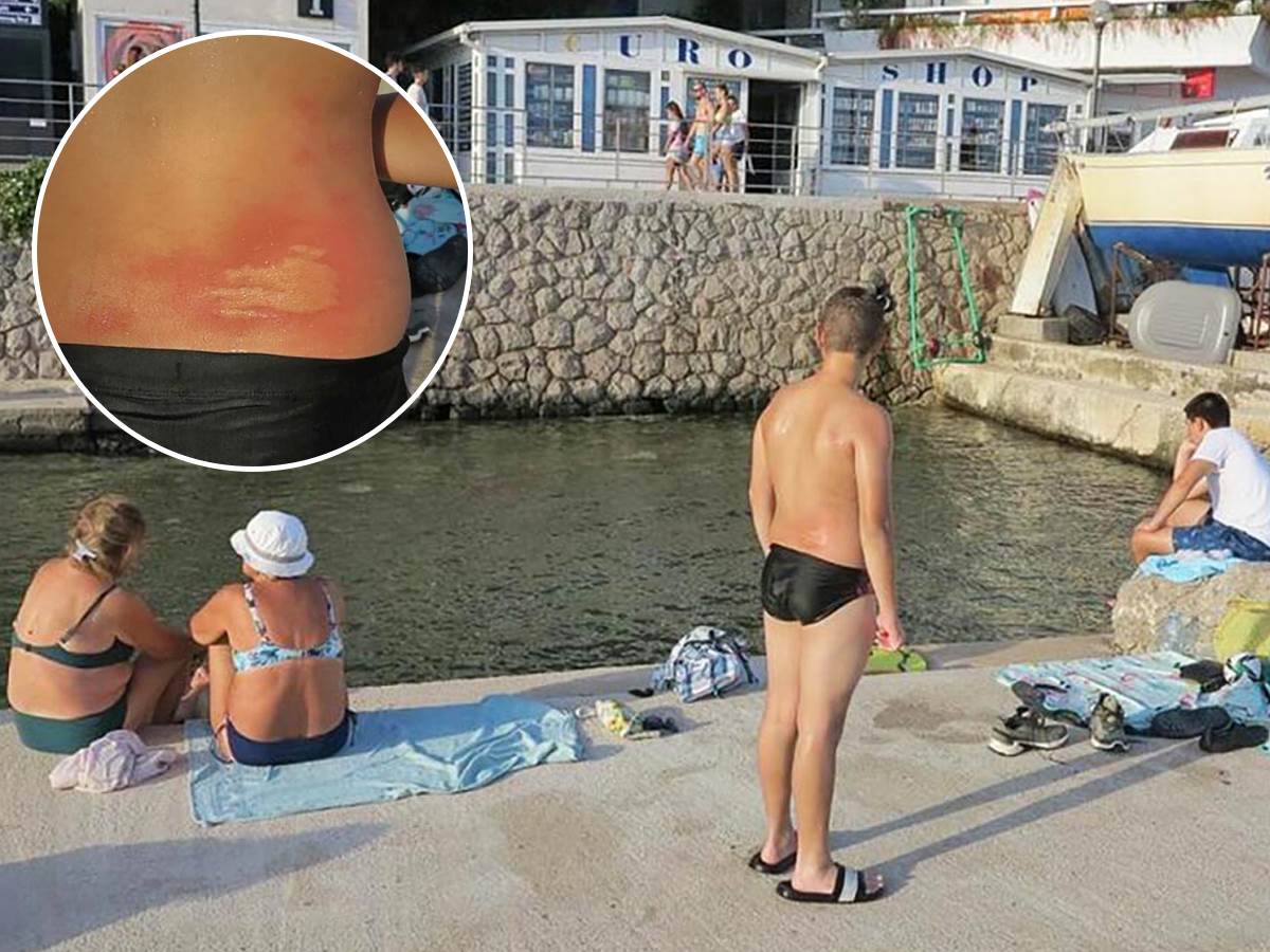  Dečak u Herceg Novom dobio opekotine od meduze 
