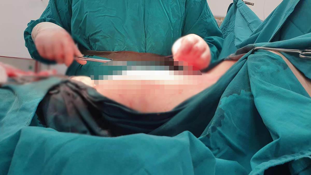  Ženi izvadili tumor od 20 kilograma 