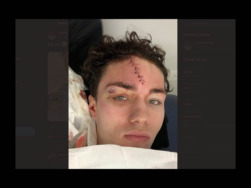  Kalum O'Hare (Koventri/Aston Vila): Povreda glave na Instagram, Facebook i Twitter profilu FOTO 