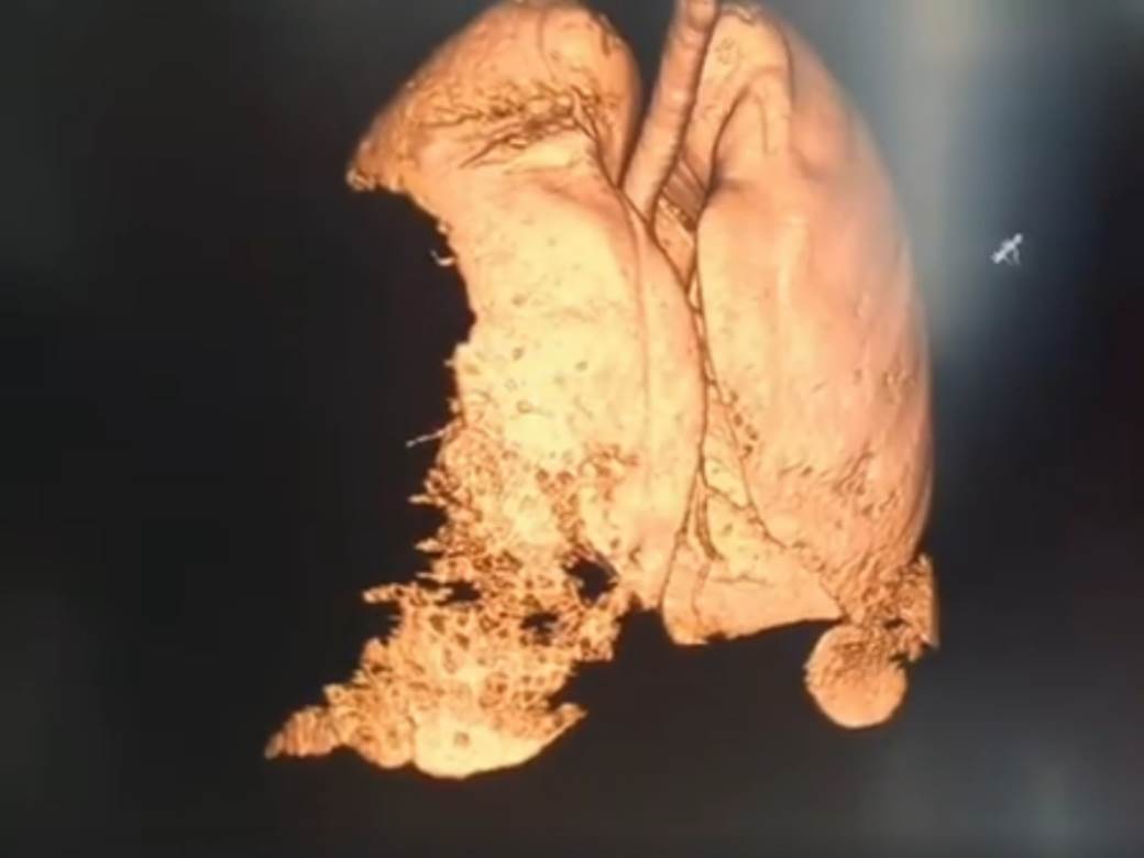  korona virus snimak kako izgledaju pluća zaraženog pulmolog Dejan Žujović 