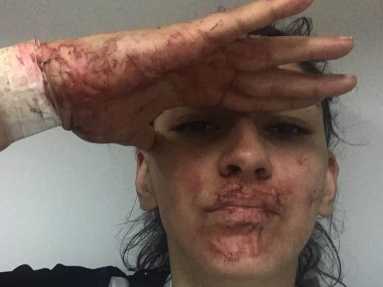  fudbalerka krvavo lice modrice foto facebook borba fudbal 
