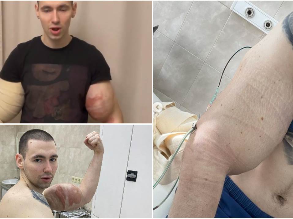  kiril teresin bicepsi rus ubrizgao ulje u bicepse operacija mu spasla zivot 