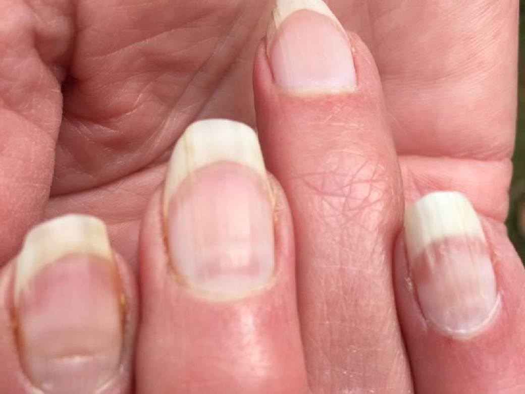  simptomi prelezane korone promene na noktima 