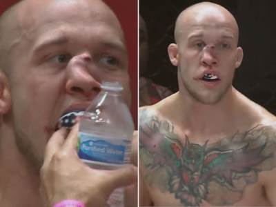  Slomljen nos MMA borca Blejka Perija 