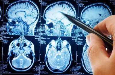  Migrene i glavobolja utiču na mozak 