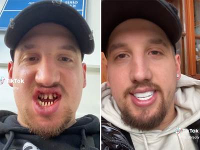  Nemac pre i posle veštačkih zuba 