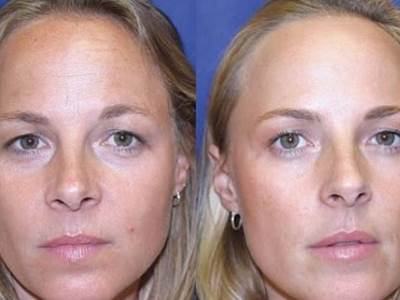  Sestre bliznakinje uporedile lice sa botoksom i bez botoksa 