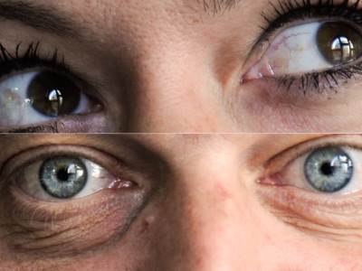  Šta znače bele mrlje kada zatvorite oči 