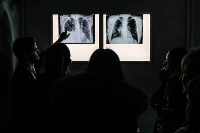  Skrining pluća otkriva rak 
